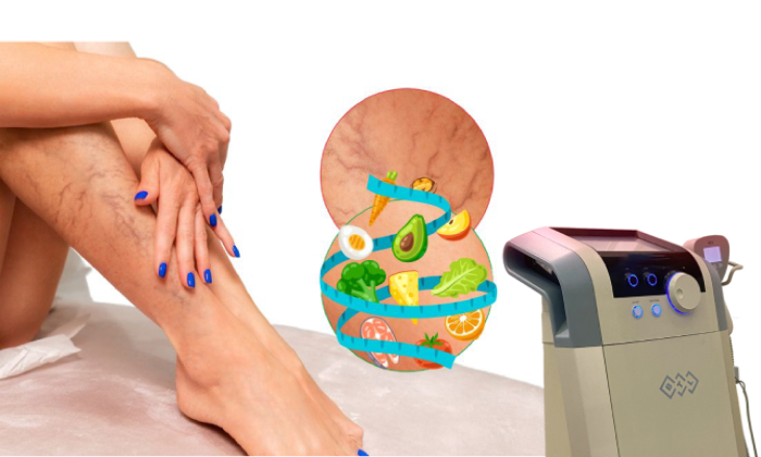 آیا لاغری سریع باعث ایجاد واریس می‌شود؟